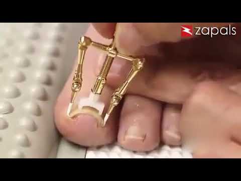 מכשיר מקצועי ליישור ציפורן חודרנית