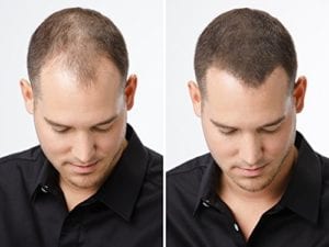 תכשיר לטיפול בנשירת שיער "מינוקסידיל 5%" לגבר - ערכה לשישה חודשים