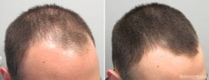 תכשיר לטיפול בנשירת שיער "מינוקסידיל 5%" לגבר - ערכה לשישה חודשים